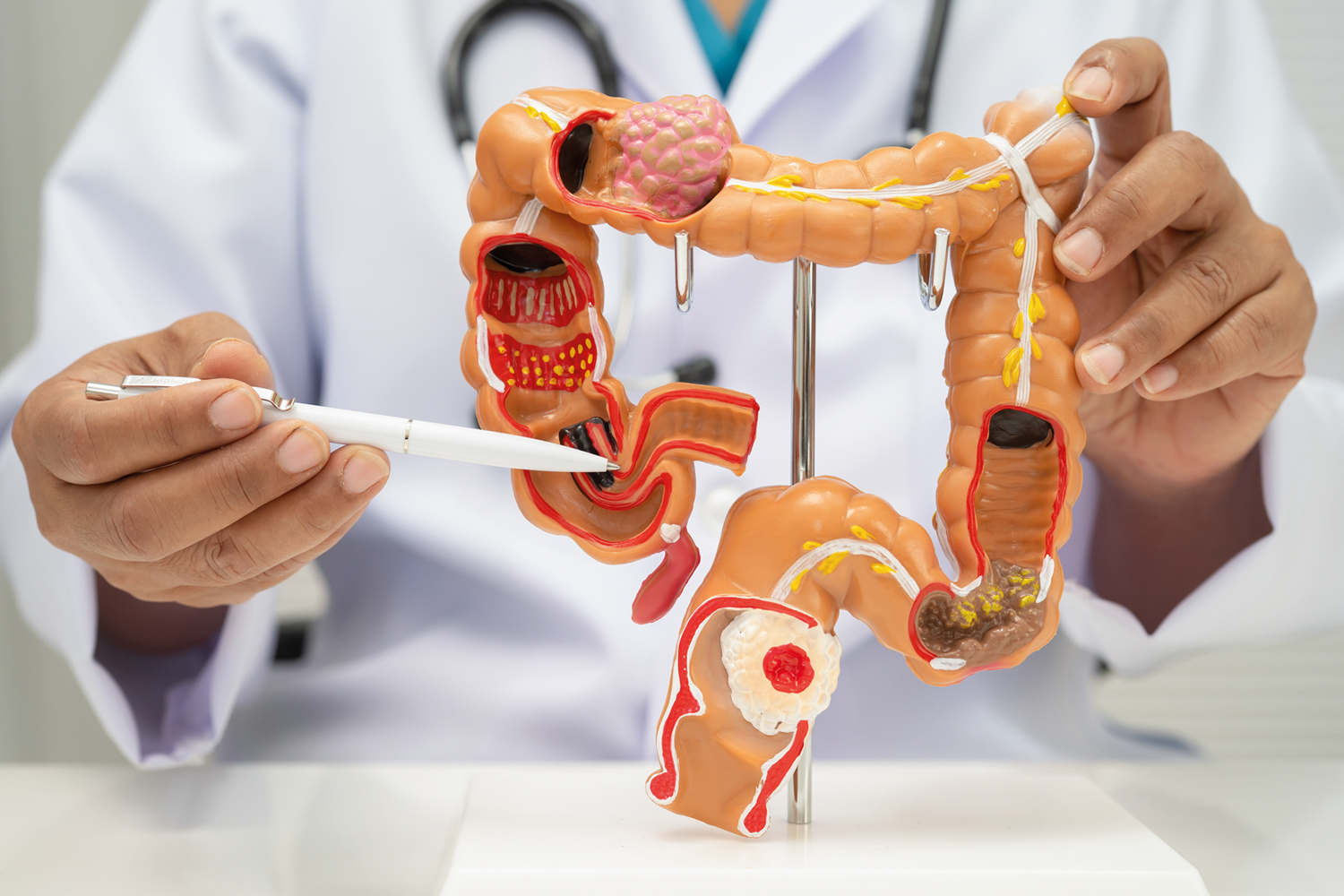 Relação entre câncer de intestino, obesidade e novas terapias