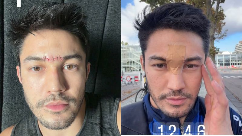 Arthur Nory se acidenta e é socorrido durante Mundial de Ginástica Artística