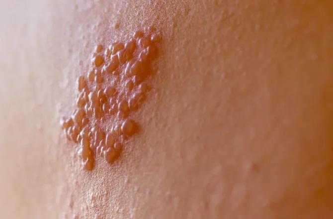 Vacina contra herpes-zóster previne dor crônica e lesões na pele
