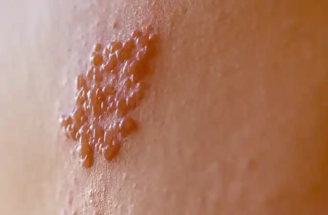 Vacina contra herpes-zóster previne dor crônica e lesões na pele