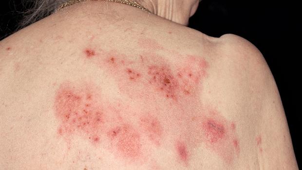 Estudo revela risco de herpes associado a canetas de emagrecimento