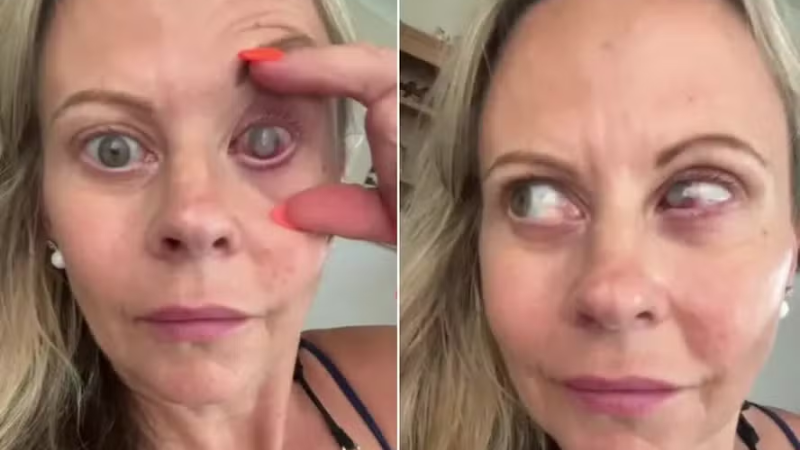 Ex-personal trainer alerta sobre riscos de infecção ocular